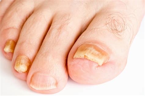 Topical terbinafine effective against mild-to-moderate onychomycosis ...