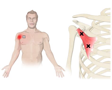 The Pectoralis Minor Muscle, Its Attachments And Actions - Yoganatomy