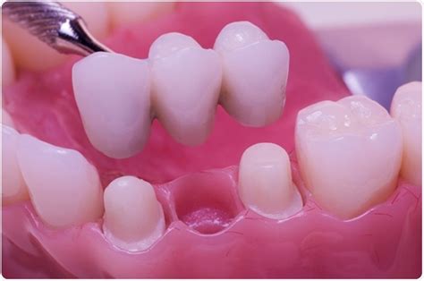 Types of Dental Bridges