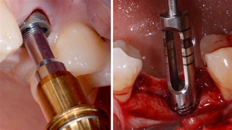 INTEGRATED IMPLANT REMOVAL. PREDICTABLE PROTOCOL AND SAFE TECHNIQUE - dentalsurgerychannel.com