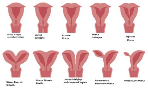 What is Complete Uterus Didelphys and How Does It Affect Pregnancy in 6 Ways?