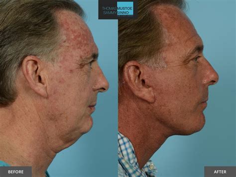 8 Facelift Before-and-After Photos That Prove Just How Natural Today’s ...