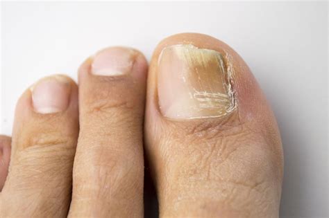 Damaged Nail Matrix Treatment