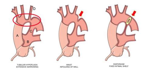 Coarctation of the Aorta : WFSA - Resources