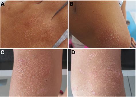 Frictional lichenoid dermatitis: A skin disorder with many names - Pediatrics & Neonatology