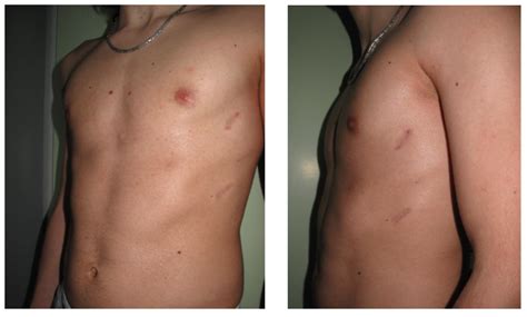 Pectus Excavatum Before And After