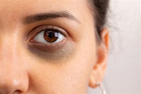 Black Eye: Causes, Treatment, & Complications