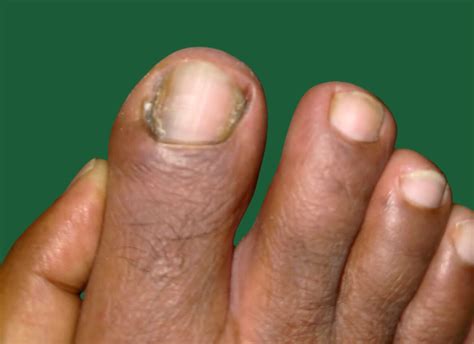 Inflammatory Nail Disorders - Uniqueskin Solutions