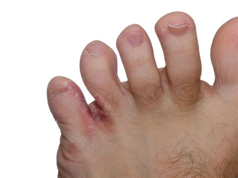 common fungal infections athlete's foot | Epiphany Dermatology