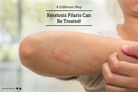 4 Different Way Keratosis Pilaris Can Be Treated! - By Dr. Purvi C Shah ...