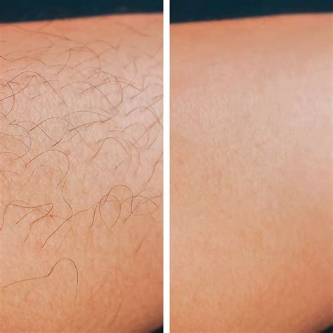 Laser Hair Removal Legs Before And After