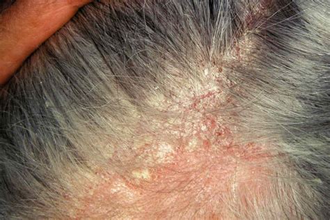 Seborrheic Dermatitis vs. Psoriasis: Scalp Differences