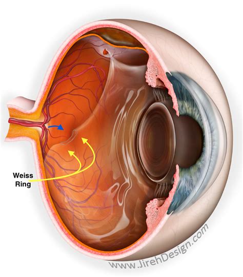 What is a PVD? | Posterior Vitreous Detachment - Treatment for Floaters