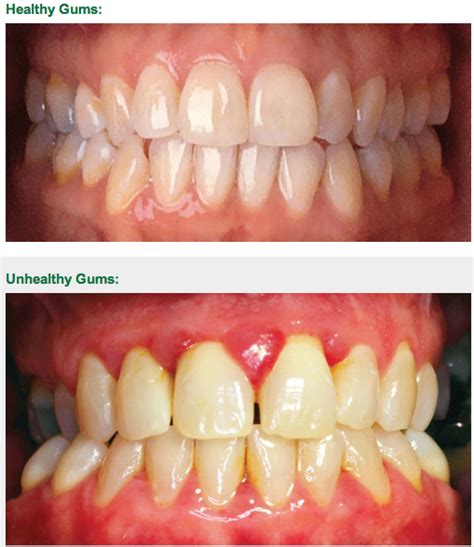 Healthy Vs Unhealthy Gums : Healthy vs Unhealthy food - YouTube, Maybe ...