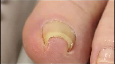 This method of fixing an ingrown toenail is both genius and disgusting - Irish Mirror Online