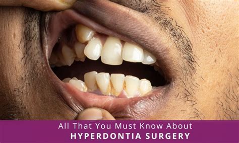 Hyperdontia Surgery: Causes, Cost, Recovery