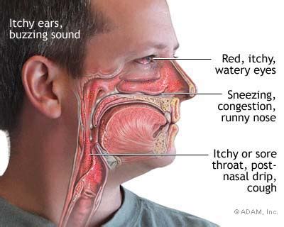 Allergies Symptoms: Symptoms Nasal Allergies