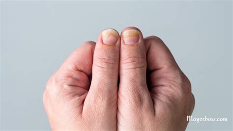 Fungal Nail Infection Causes Symptoms And Treatment - vrogue.co