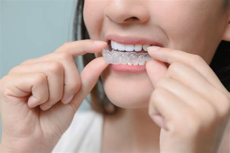 4 Things To Know About SureSmile Clear Aligners