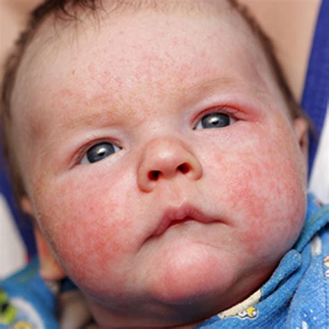 Eczema Skin Rashes On Babies