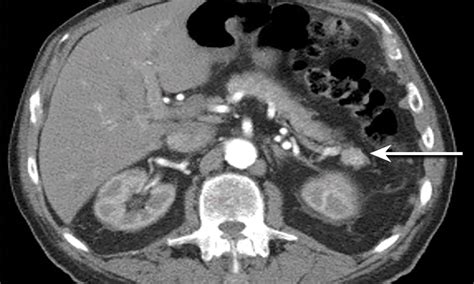 Insulinoma: important in the differential diagnosis of persistent ...