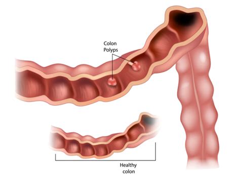 Colon Polyp Treatment in San Jose, CA | Colon Polyps Removal