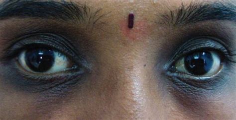 Removal of Dark Spots Under Eyes + Creams - Skincarederm
