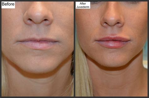 Lip Fillers Before and After Thin Lips