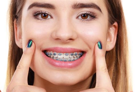 Fast Braces Pros and Cons: Should You Get Them?