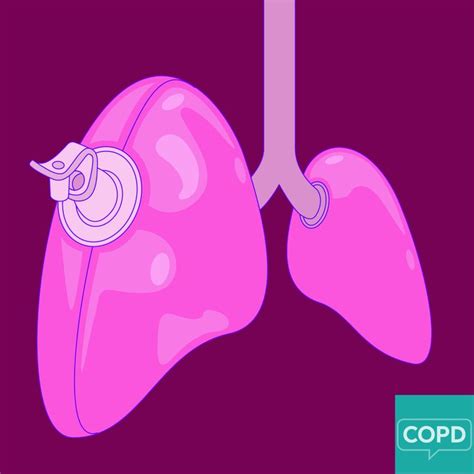 Lung Hyperinflation in COPD | Copd, Lunges, Chronic obstructive pulmonary