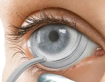 Artificial Cornea and Corneal Implant Market