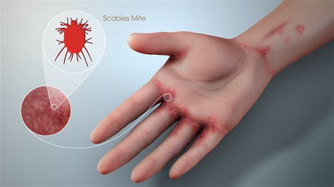 Scabies: Symptoms, Causes, and Treatment - Scientific Animations