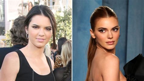 Kendall Jenner Nose Job: What Happened and the Latest Update ...