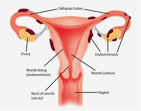 Endometriosis - askep