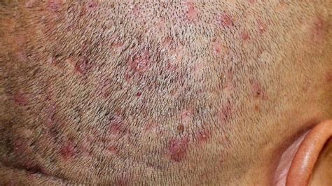 Scalp scab: The ideal way to deal with it