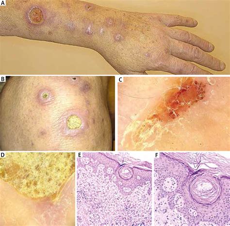 The diagnostic process of Kyrle’s disease in a 65-year-old patient