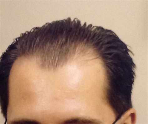 Case-11837 | Leonard Hair Transplant Associates