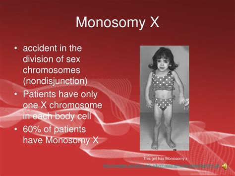 PPT - Turner Syndrome PowerPoint Presentation, free download - ID:4837737