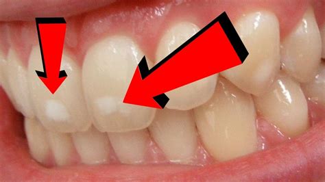 What Causes White Spots on Teeth | How To Cure it - Home Remedies - YouTube