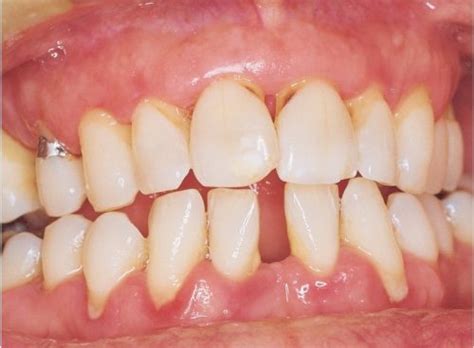 subgingival calculus Archives - Dentistry Today