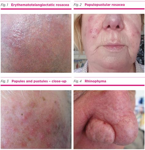 Acne Rosacea Vs Lupus Rash - Lupus Misdiagnosis Diseases That Can Mimic Lupus : This is commonly ...