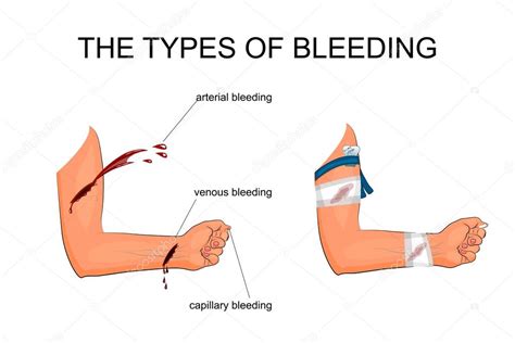 The types of bleeding — Stock Vector © Artemida-psy #113967188