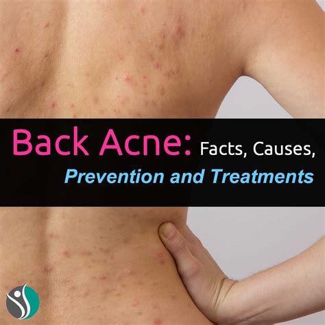 Back Acne: Facts, Causes, Prevention, and Treatments %% - ConsumerHealthWeekly.com