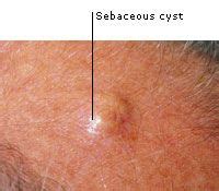 Sebaceous Cyst Bikini Line