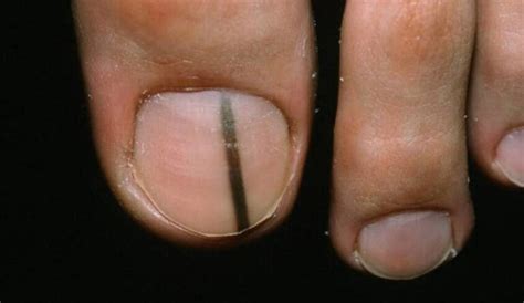 melanoma under nail pictures | Symptoms and pictures