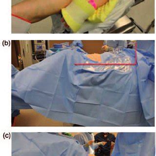 (PDF) Robotic-assisted laparoscopic mesh sacrocolpopexy