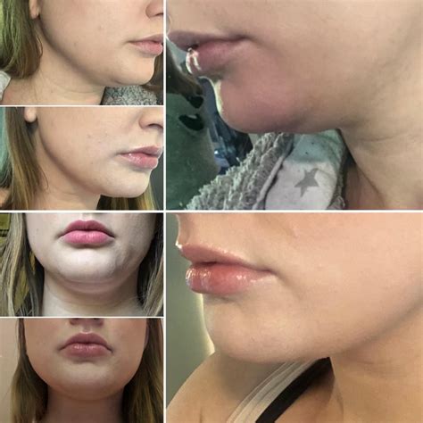 Coolsculpting mini for double chin before and after (3 week progress) I ...