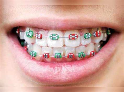 Fake braces fad can be dangerous - Times of India