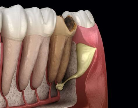 How to treat fistula on the gums | Stomatološka poliklinika Smile