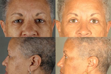 Blepharoplasty Upper and Eyelids G7 | Summit Health